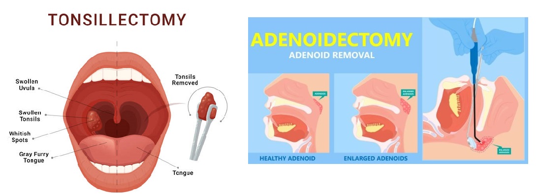 Best ENT Surgeon For Tonsillectomy & Adenoidectomy In Navi Mumbai